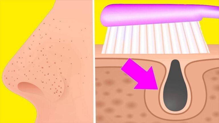 Dieser einfache Trick entfernt Mitesser auf der Nase und sorgt für strahlende Haut…