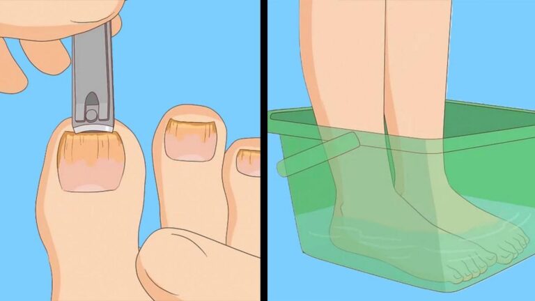Dieser vergessene Trick lässt Nagelpilz schnell verschwinden… entdecke die einfache