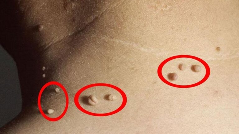 Ein einfacher Trick, um lästige Hautanhängsel schnell und dauerhaft loszuwerden…
